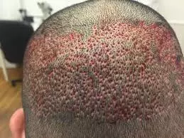 Activated Follicular Transplant Stage 02