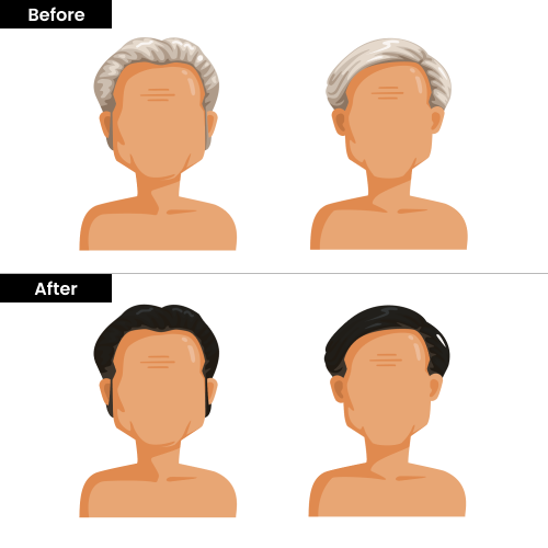 stages of male baldness pattern