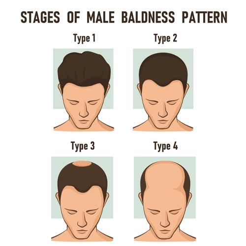 Hair Thinning In Males And How To Fight It  Traya