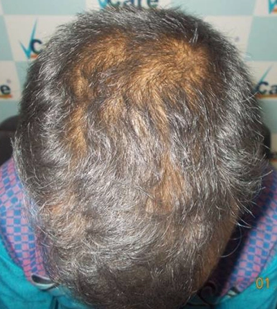 Before After - Hair Loss Treatments - VCare Trichology