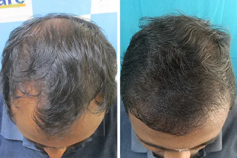 Before After - Hair Loss Treatments - VCare Trichology