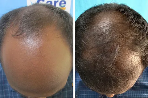 Before After - Hair Loss Treatments - VCare Trichology