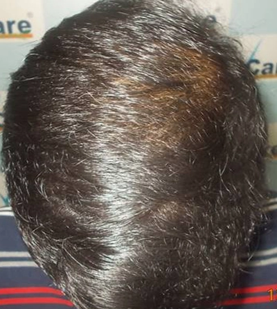 scalp_micro_treatment_after_image_vcare